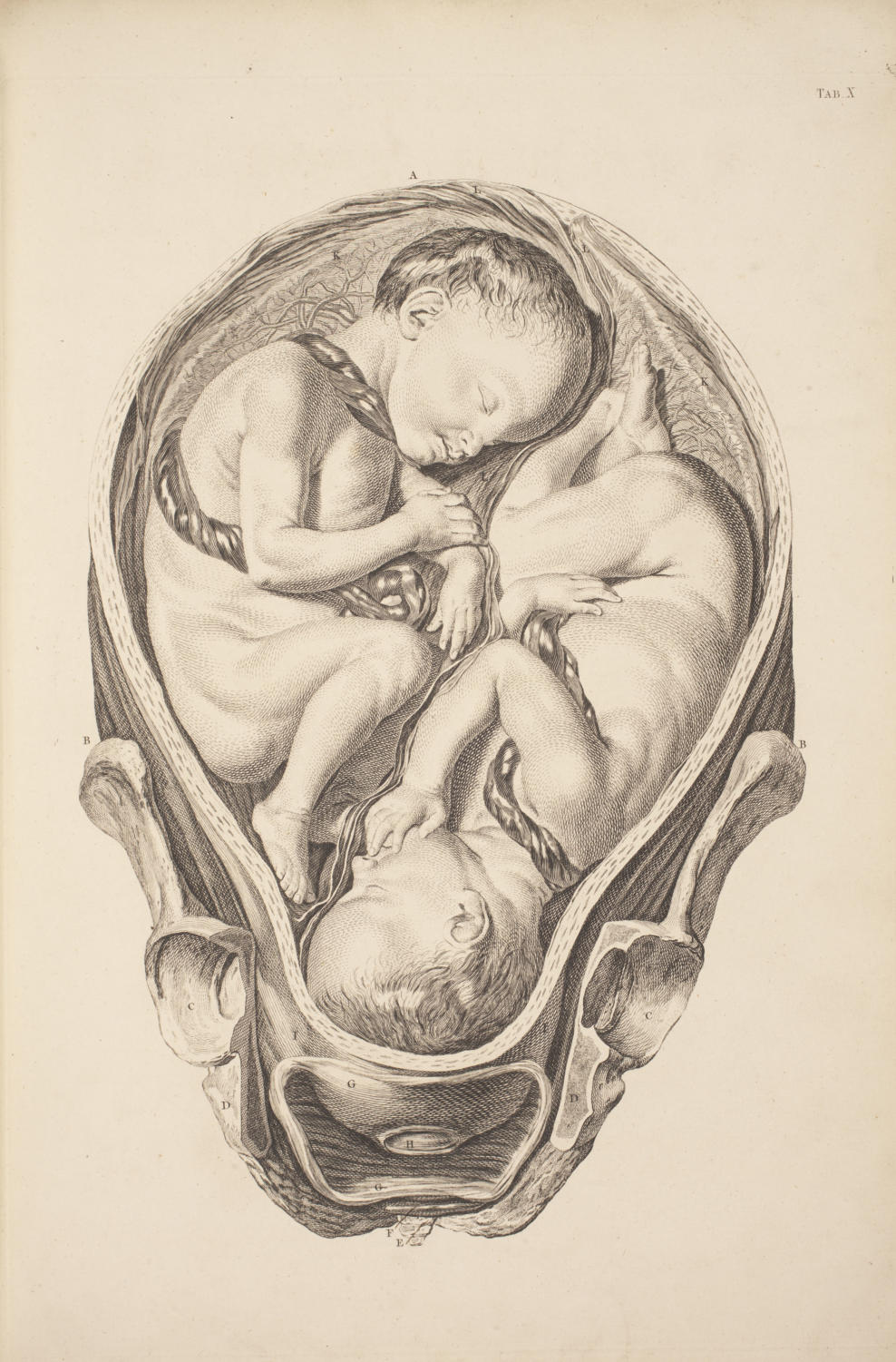 Twins in a mother’s womb encased by the bony pelvis. Smellie, A set of anatomical tables, with explanations, and an abridgement, of the practice of midwifery, 1754.